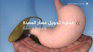 عملية تحويل مسار المعدة بهدف تقليل الوزن  Gastric Bypass