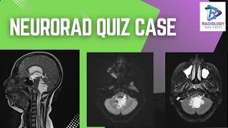 Crack the Case Neurorad Quiz Challenge  Dr. Umamaheswara Reddy .V