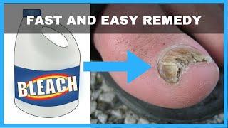 How to Get Rid of Toenail Fungus with Bleach - Toe Fungus Journey