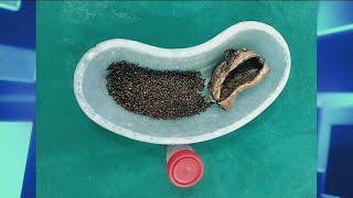 Thousands of Gallstones Removed from Patient