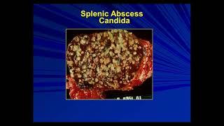 Imaging findings Diffuse and focal lesions of spleen