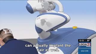Introducing Artas Robot iXi The Future of Hair Transplants at Advanced Cosmetic Surgery