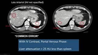 Interpreting CT Abdo Background Liver Hepatic Steatosis High Attenuation Liver