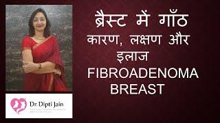 FIBROADENOMA BREAST  ब्रैस्ट में गाँठ कारण लक्षण और इलाज  Dr Dipti Jain Ahmedabad