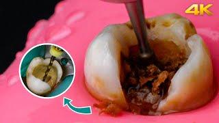 AMAZING Root Canal Treatment Process in 4k