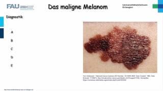 Dermatologie ─ Malignes Melanom