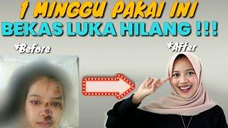 1 minggu pakai ini bekas luka hilang