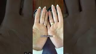 Sweaty hands gang  Dermadrys iontophoresis solution for sweaty hands
