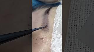 Follicular Unit Excision. Xi’an Eyebrow Transplantation Education