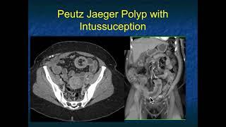 CT Evaluation of Small Bowel Tumors Detection & Classification - Part 3