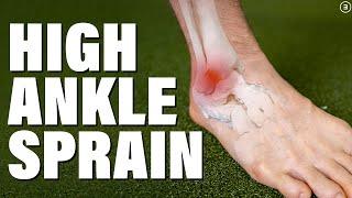 High Ankle Sprain  Syndesmosis Injury Evaluation  Education  Exercises