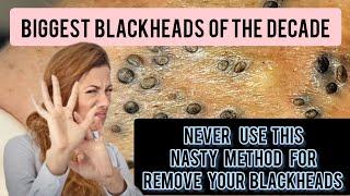 Nasty and lengthy blackhead removal bent needle historical method...  @Dr.AMAZINGSKIN