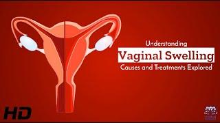 Vaginal Swelling Explained Insights on Treatment Options