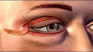 Cosmetic Eye and Eyelid Surgery - 3D Medical Animation  ABP ©