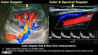 What Do Red And Blue Colors Mean? Color & Spectral Doppler Ultrasound Interpretation  USG Physics