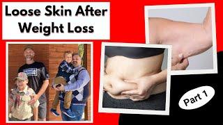 Loose Skin After Weight Loss Causes and Prevention Strategies