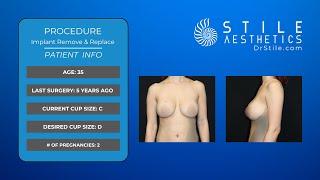 Journey to Remove & Replace Breast Implants - Live Surgery