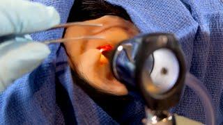 ASMR Removing a Foreign Object from Your Ear  Doctor & Patient POV  Hearing Test