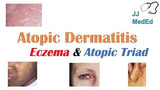 Eczema Atopic Dermatitis  Atopic Triad Triggers Who gets it Why does it happen & Treatment