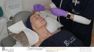 ReLife Menarini Definisse Peel Program - Instagram Clip - Real You Clinic