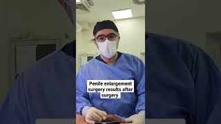 Penile enlargement surgery results after surgery by Dr Araz Bayramov #andrologist #urologist