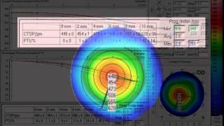 Enhanced Screening for Ectasia