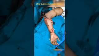 First successful replantation of forearm in AIIMS Bhubaneswar