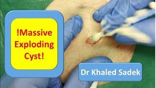 Massive 20 year Cyst Explosion. LipomaCyst.Com Dr Khaled Sadek