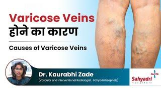 Varicose Veins होने का कारण  Causes of Varicose Veins  Dr Kaurabhi Zade Sahyadri Hospitals