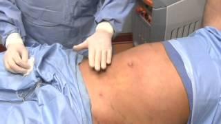 Smartlipo Atlanta Laser Liposuction Demonstration Part II