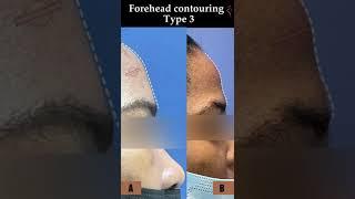 Forehead Contouring Type 3  #shorts  #youtubeshorts