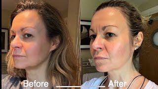 NuFace microcurrent review My before and after results 4 months in