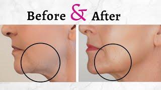 Improving lines wrinkles texture & crepey skin on face neck chest & hands at 60 