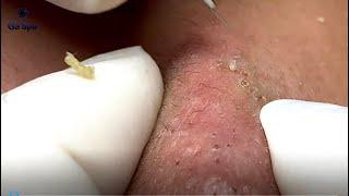 If You Like Squeezing Acnes Youll Must be See This Video  Full 33 Minutes  GaSpa 18.03.2022