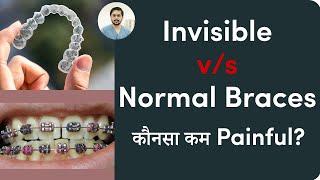 Invisible braces में कितना दर्द होता है?  Are Invisible braces painful explained by Dr Ankit Indore