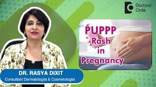 Ruam PUPPP pada Kehamilan Penyebab Gejala Pencegahan & Pengobatan - Dr. Rasya Dixit  Lingkaran Dokter