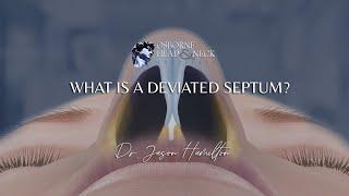 What is a deviated septum?