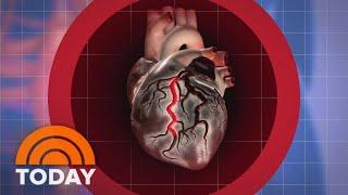 Why are young healthy adults experiencing a rise in heart attacks?