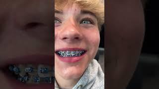 Braces Color Options  3 Cool Styles...