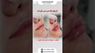 #پوست_زیبا #skincare #پوست_مو تزریق ژل لب متخصص پوست کرج دکتر میمند #beauty #doctor