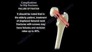 Complications In Hip Fractures