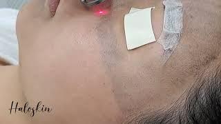 Relaxing Laser Carbon Peel Halo Skin Hong Kong