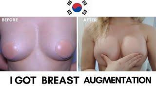 I Got Breast Augmentation in Korea - Before and After  Seoul Guide Medical