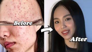 5 tips for Clear Skin How I got rid of Acne  Breakouts Remedy at home skin care routine x AMRIO