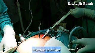 Handmade Endobag and Insertion Technique by Dr.Avijit Basak