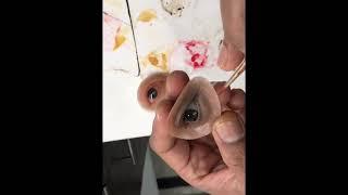 #siliconeye #artificialeye #orbitalprosthesis #siliconorbitalprosthesis #suvidhaeyeservices