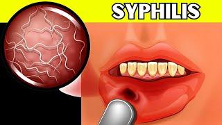 Syphilis - Causes Signs & Symptoms Pathogenesis Diagnosis And Treatment