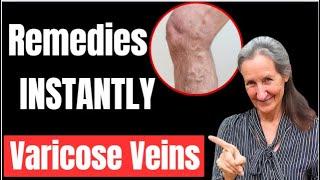 shocking Remedies For Varicose Veins and Swollen Legs  INSTANTLY  Barbara ONeills