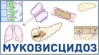 Муковисцидоз - причины симптомы диагностика лечение