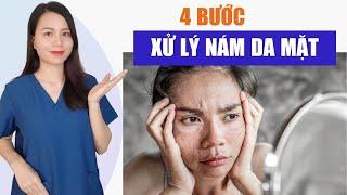 4 bước trị nám da mặt tại nhà - đơn giản tiết kiệm ai cũng làm được   Nguyễn Mai Hương